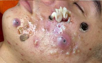 Blackheads Causes and treatment - 𝐁𝐞𝐬𝐭 𝐁𝐥𝐚𝐜𝐤𝐡𝐞𝐚𝐝 𝐑𝐞𝐦𝐨𝐯𝐚𝐥 𝐄𝐯𝐞𝐫 𝐒𝐡𝐨𝐮𝐥𝐝 𝐏𝐨𝐩𝐩𝐢𝐧𝐠