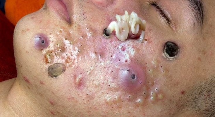 Blackheads Causes and treatment - 𝐁𝐞𝐬𝐭 𝐁𝐥𝐚𝐜𝐤𝐡𝐞𝐚𝐝 𝐑𝐞𝐦𝐨𝐯𝐚𝐥 𝐄𝐯𝐞𝐫 𝐒𝐡𝐨𝐮𝐥𝐝 𝐏𝐨𝐩𝐩𝐢𝐧𝐠