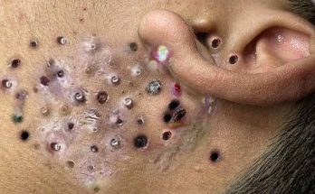 How to Remove Blackheads Safely