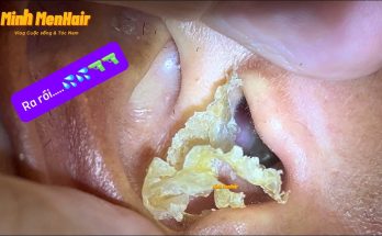 Earwax- Asmr Huge Ear Wax Finally Removed After 10 Years