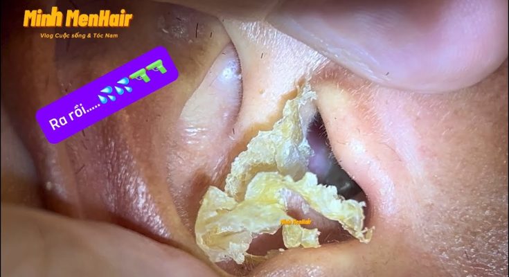 Earwax- Asmr Huge Ear Wax Finally Removed After 10 Years