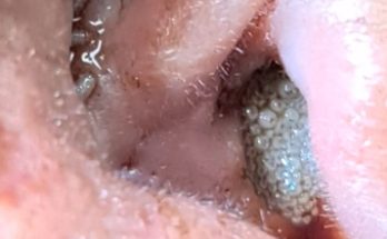 Maggots in Ear Canal! Amazing Removal!