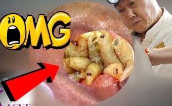 OMG Worms In The Ear - Removal Worms From Ear