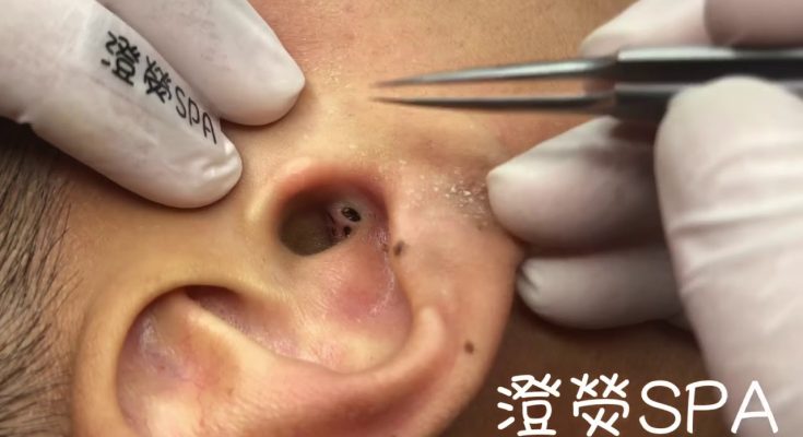 Why Blackheads Form in Your Ears and How to Treat Them