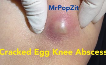 Cracked Egg Knee Abscess. Large mass on knee under pressure and painful. Pressure relieved.