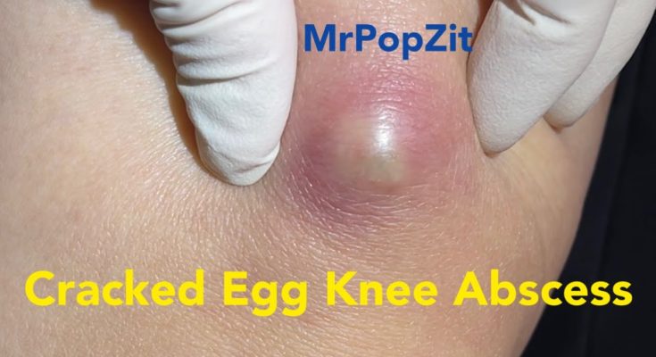 Cracked Egg Knee Abscess. Large mass on knee under pressure and painful. Pressure relieved.