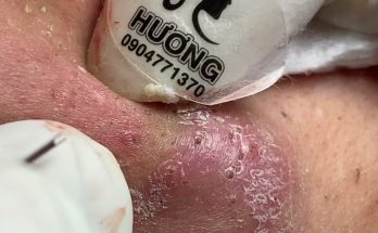 Make your Acne Treatment Huong Da Nang |