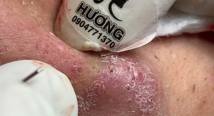 Make your Acne Treatment Huong Da Nang |