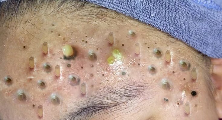 How do I get rid of blackheads safely?