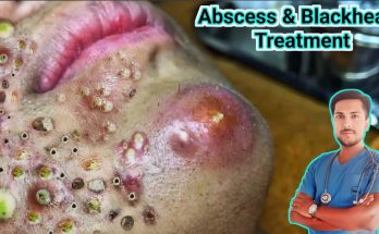 Abscess Treatment: Causes, Symptoms and Removal"