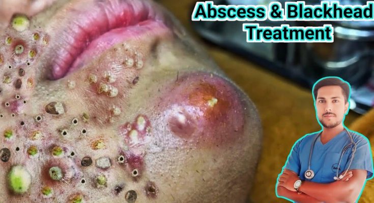 Abscess Treatment: Causes, Symptoms and Removal"