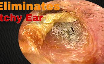 The Itching Stopped after Removing Earwax