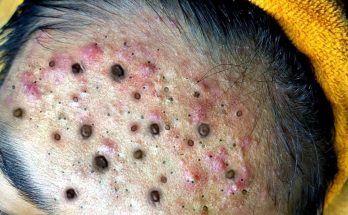 How to Get Rid of Blackheads