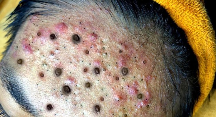 How to Get Rid of Blackheads