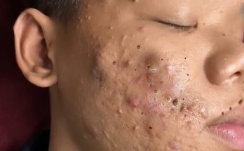 Make your Acne Treatment Huong Da Nang