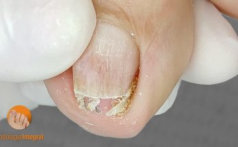 How To Treat an Ingrown Toenail