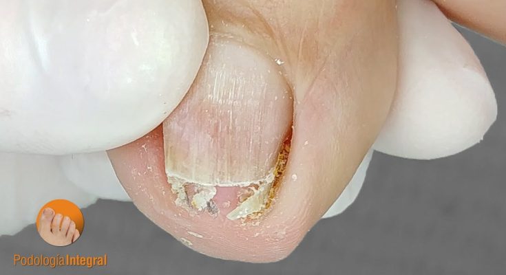 How To Treat an Ingrown Toenail