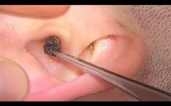 Earwax Removal