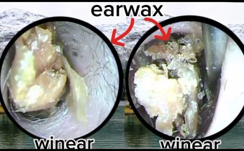 Professionally remove impurities from inside the ear