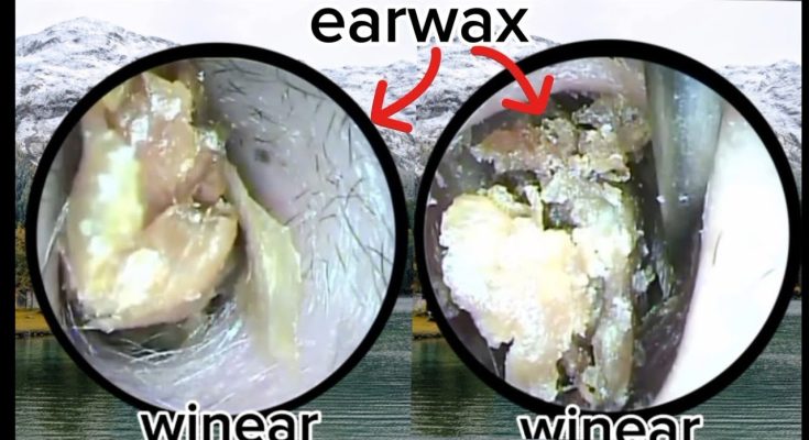 Professionally remove impurities from inside the ear