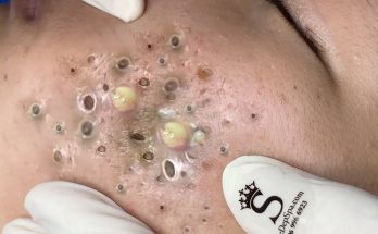 What are Blackheads?