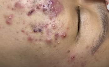 Big Cystic Acne Blackheads Extraction Blackheads & Milia, Whiteheads Removal Pimple Popping