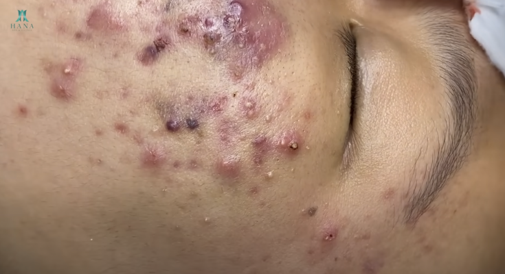 Big Cystic Acne Blackheads Extraction Blackheads & Milia, Whiteheads Removal Pimple Popping