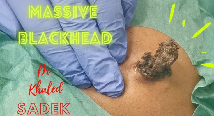 Massive 15 year Blackhead.