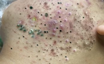 Acne Treatment Under The Skin