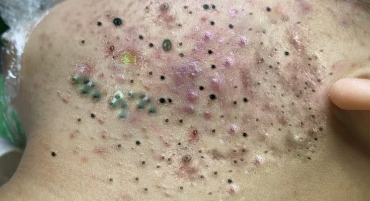 Acne Treatment Under The Skin