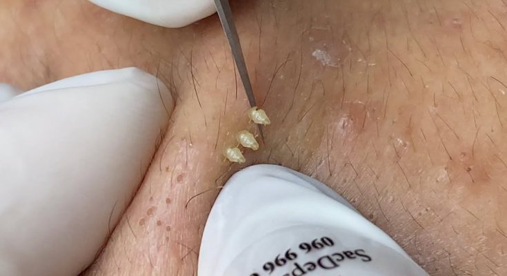 Say Goodbye to Blackheads with This Simple Trick