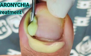 Toe Nail Fungus Infection: Paronychia Treatment & Management.