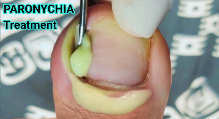 Toe Nail Fungus Infection: Paronychia Treatment & Management.