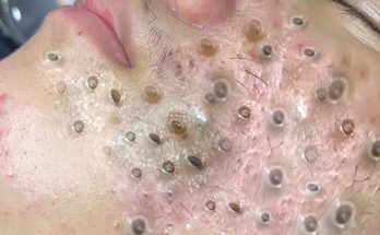 Derm reacts to massive blackhead removal!