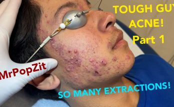 Severe hormonal acne in young patient. So many clogged pores expressed. Explosive inflammation!