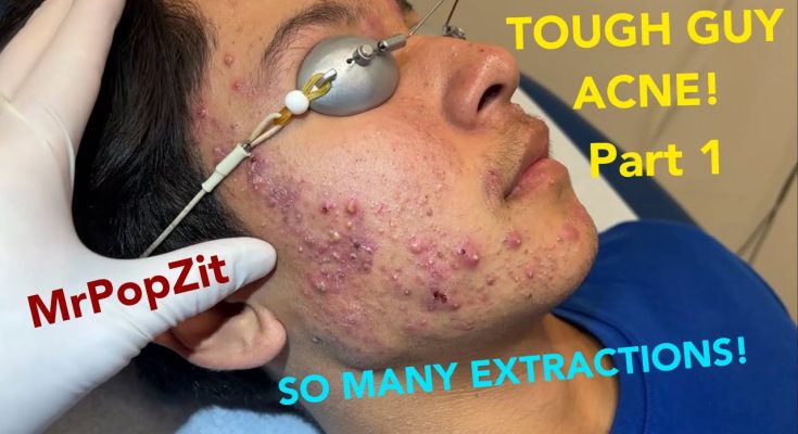 Severe hormonal acne in young patient. So many clogged pores expressed. Explosive inflammation!