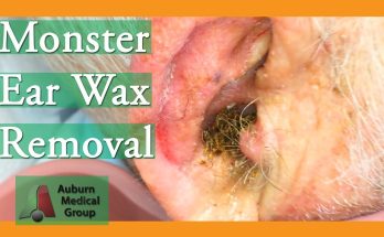 Angel's Earwax Removal | Auburn Medical Group