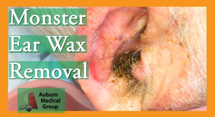 Angel's Earwax Removal | Auburn Medical Group