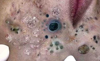 Satisfying Relaxing, What are blackheads?