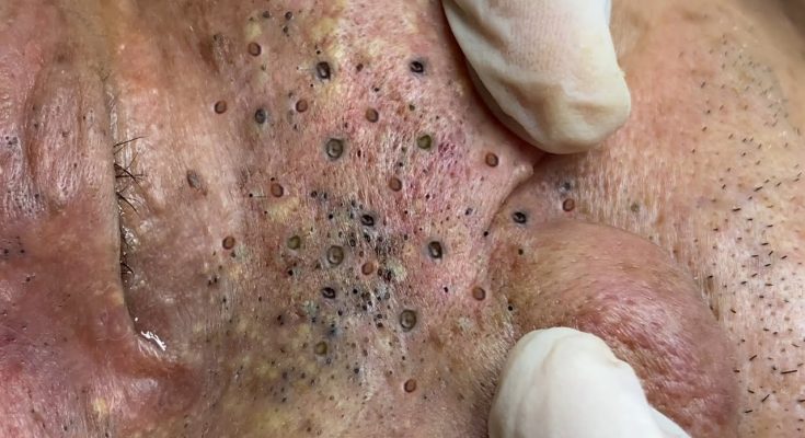 How to Treat and Prevent Deep Blackheads — Professionally or at Home