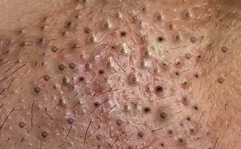 Satisfying video Blackheads are a very common skin condition that mostly affects your face, neck, back and chest.