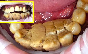 47 yo. Male's Teeth Gigantic Tartar Removal - Scaling