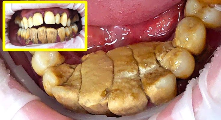 47 yo. Male's Teeth Gigantic Tartar Removal - Scaling