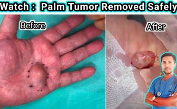 How to Remove a Palm Tumor | Tumor Cause, Symptoms & Treatment Explained