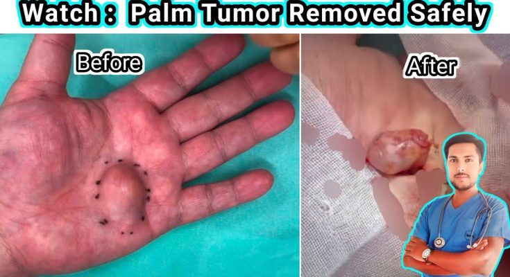 How to Remove a Palm Tumor | Tumor Cause, Symptoms & Treatment Explained