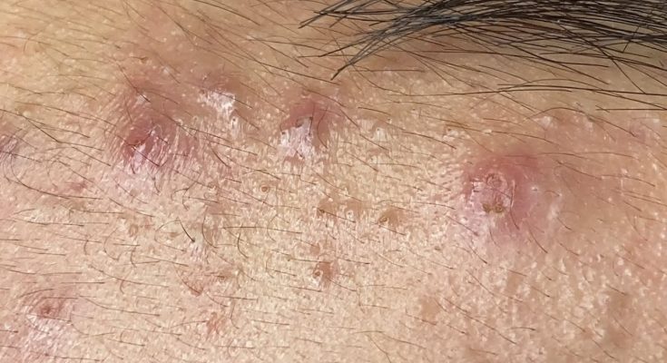 The Top 5 Treatments to Get Rid of Blackheads