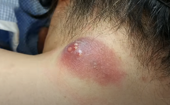 Drainage of Infected Epidermal Cyst