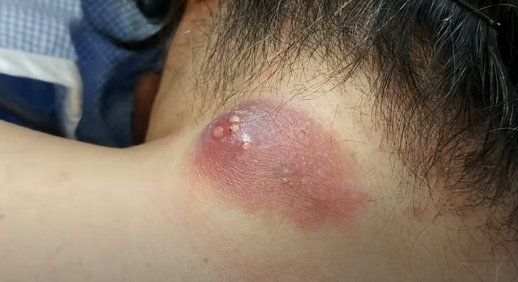 Drainage of Infected Epidermal Cyst