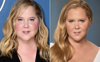 Amy Schumer Says Comments About Her 'Moon Face' Led to Cushing Syndrome Diagnosis: 'I Wouldn't Have Known'