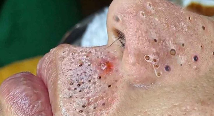 12 Ways to Get Rid of Blackheads